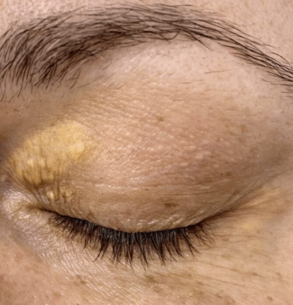 Xanthelasma