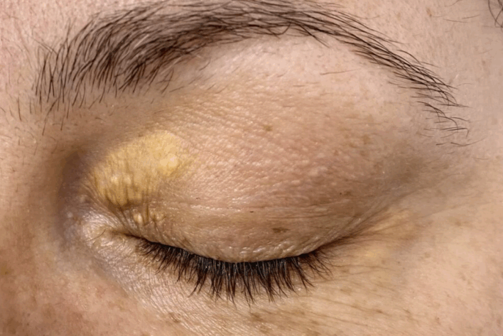 Xanthelasma